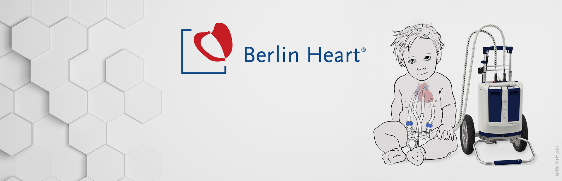 PROSTEP Group unterstützt Berlin Heart bei der ALM-Einführung